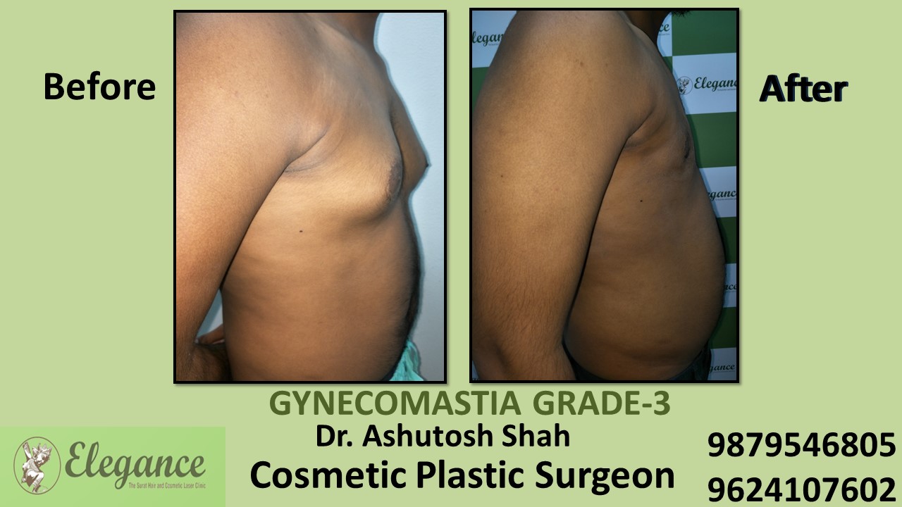 Gynecomastia Grade-3 Treatment, Chhota Udaipur, Gujarat, India.
