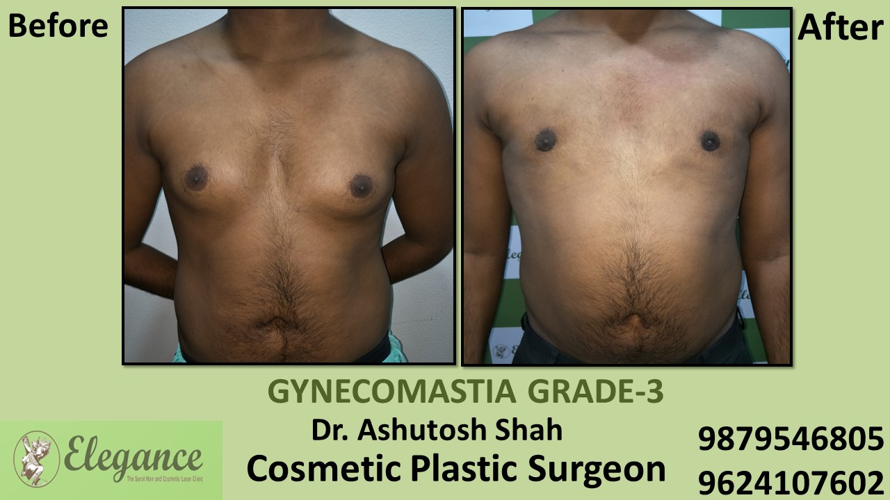 Gynecomastia Grade-3 Treatment, Chikhli, Gujarat, India.