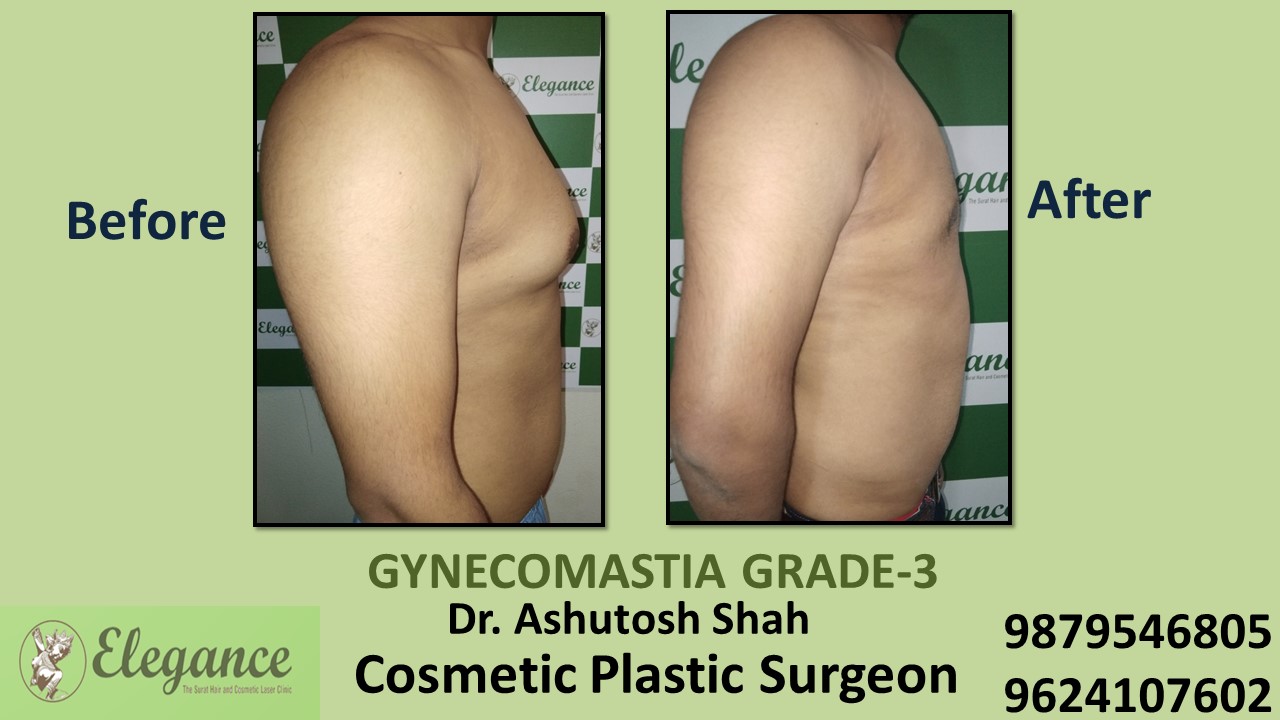 Gynecomastia Grade-3 Treatment, Citylight, Surat, Gujarat, India.