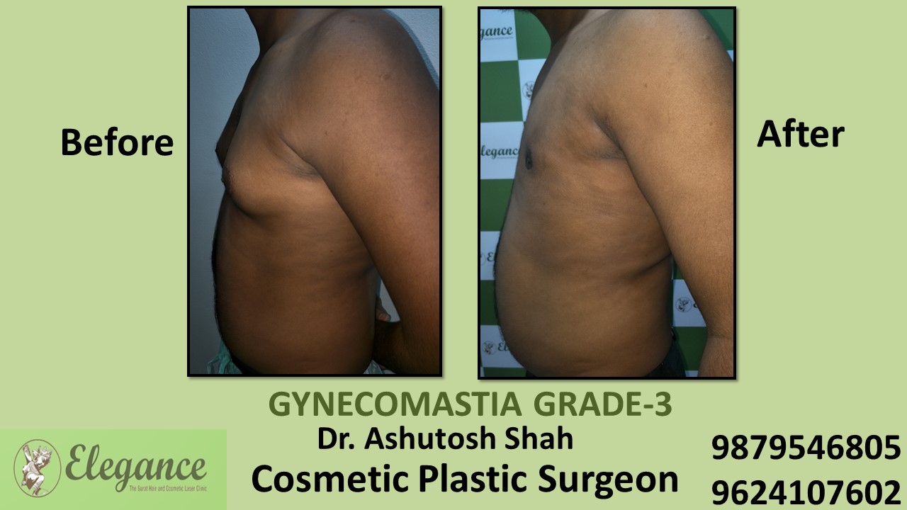 Gynecomastia Grade-3 Treatment, Daman, Gujarat, India.
