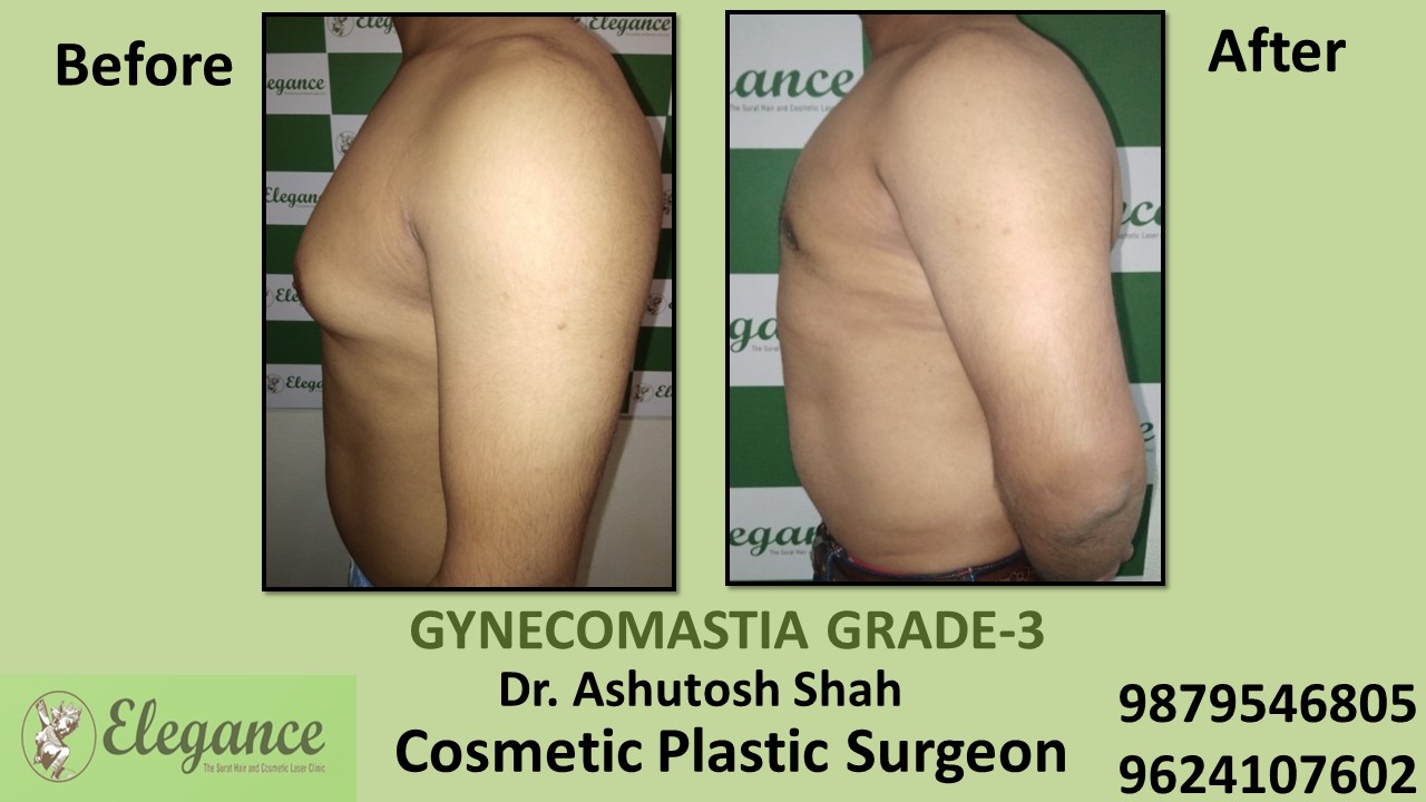 Gynecomastia Grade-3 Treatment, Hazira, Surat, Gujarat.