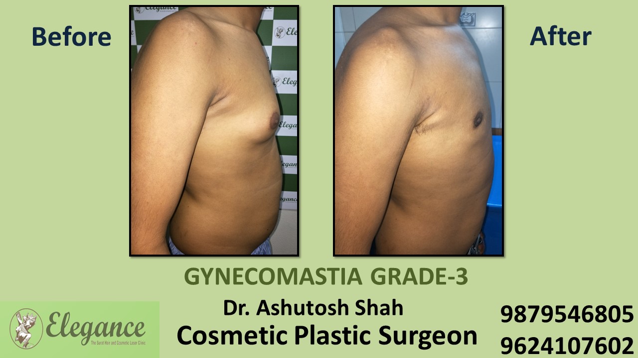 Gynecomastia Grade-3 Treatment in Athwaget, Surat, Gujarat.