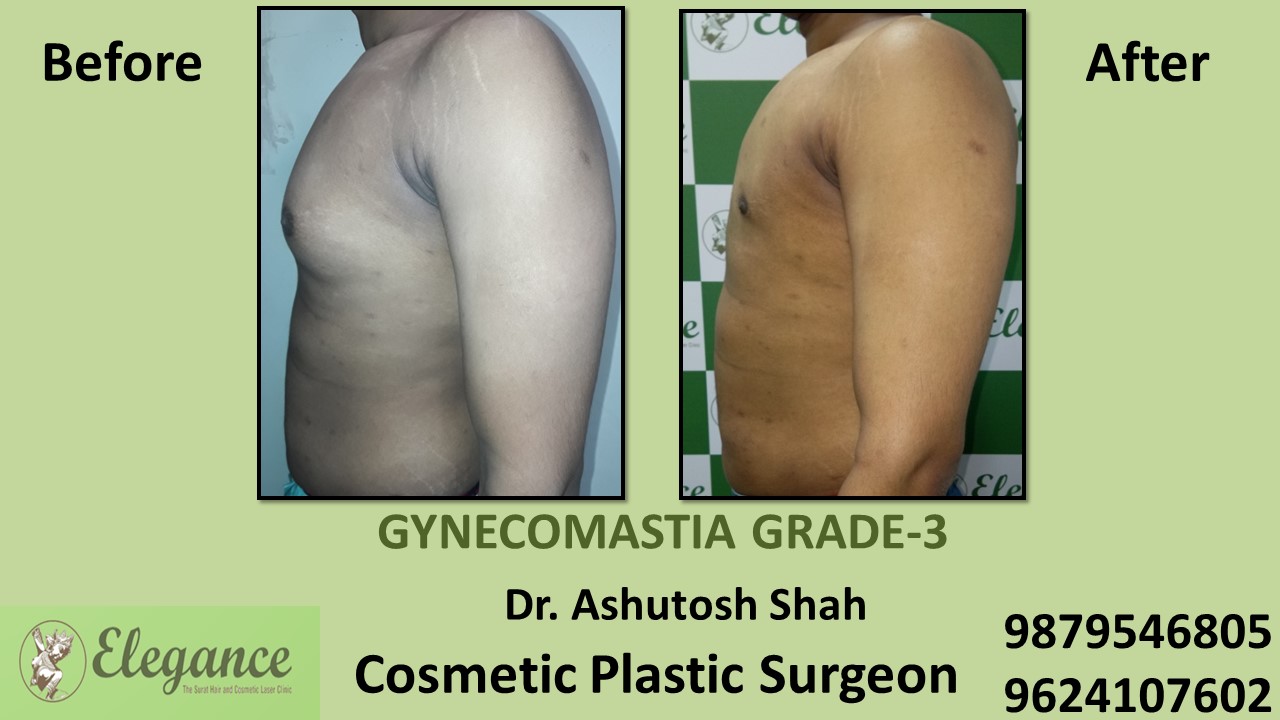 Gynecomastia Grade-3 Treatment in Chhota Udaipur, Gujarat, India.