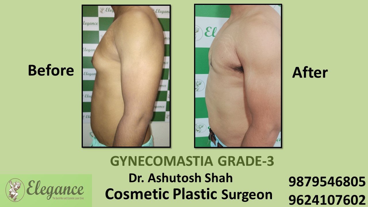 Gynecomastia Grade-3 Treatment in Chikhli, Gujarat, India.