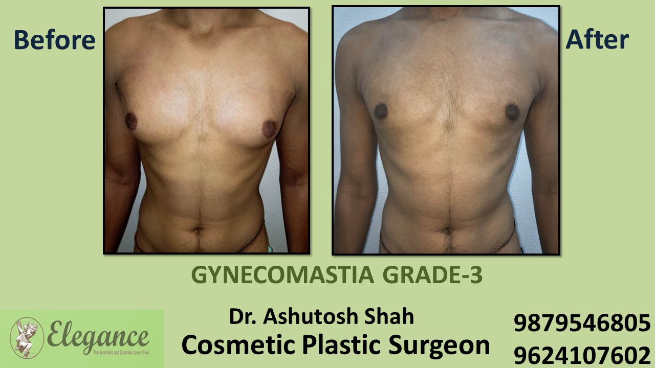 Gynecomastia Grade-3 Treatment in Citylight, Surat, Gujarat.