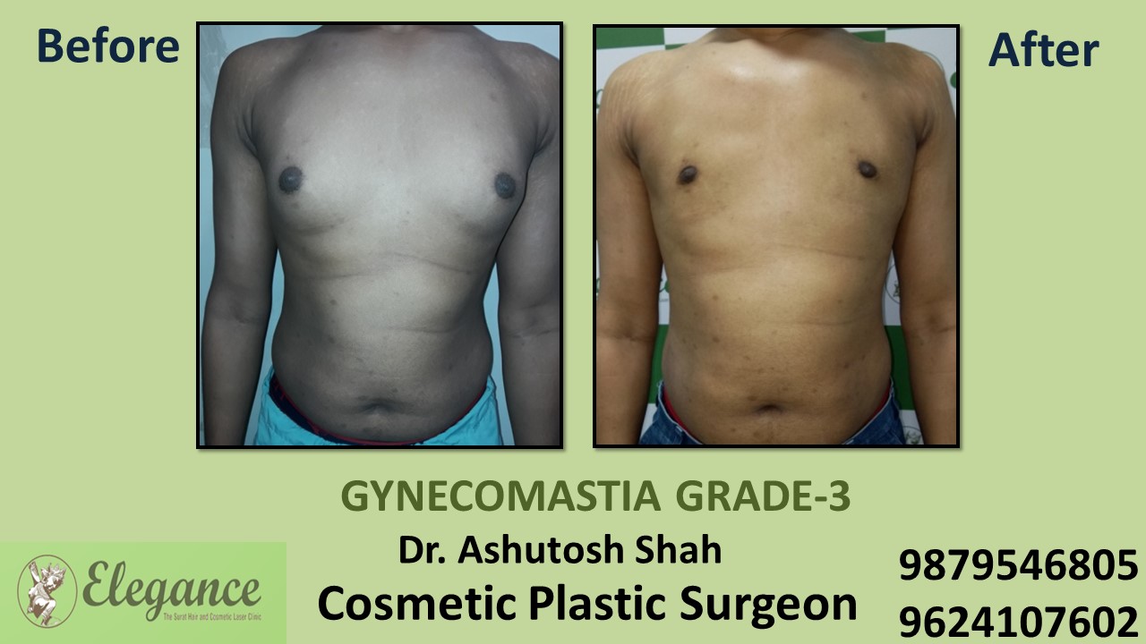 Gynecomastia Grade-3 Treatment in Daman, Gujarat, India.