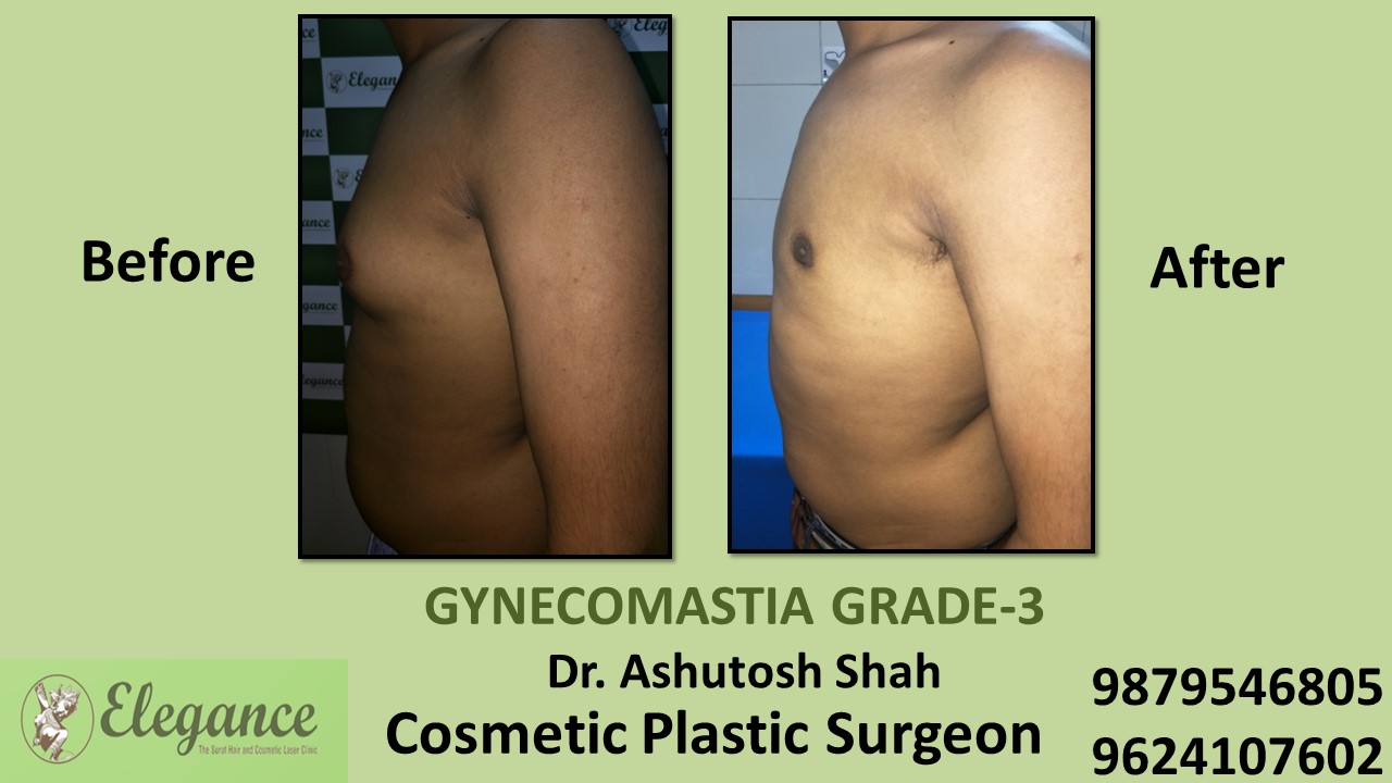 Gynecomastia Grade-3 Treatment in Hazira, Surat, Gujarat.