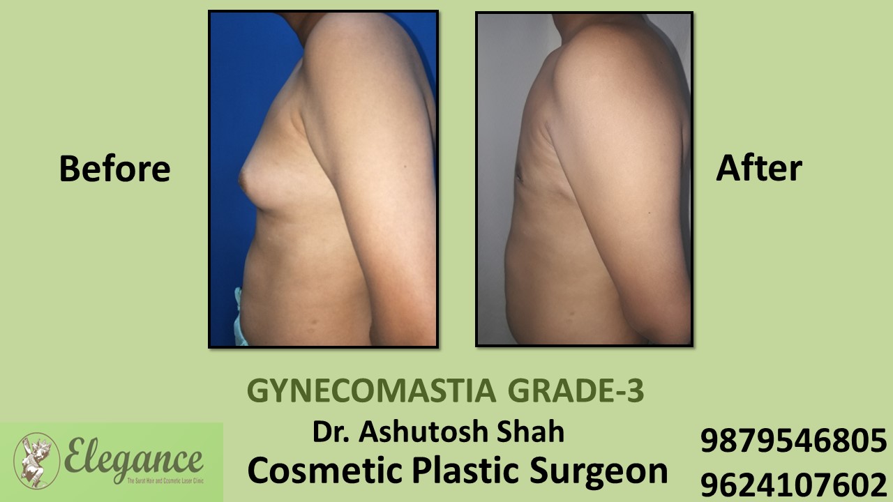 Gynecomastia Grade-3 Treatment in Kamrej, Gujarat, India.