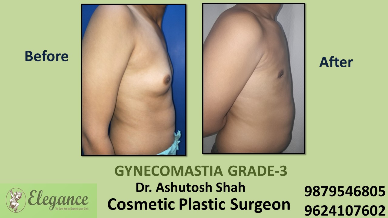 Gynecomastia Grade-3 Treatment in Kim, Gujarat, India.