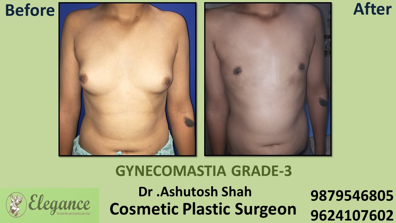 Gynecomastia Grade-3 Treatment in Kosambsa, Gujarat, India.
