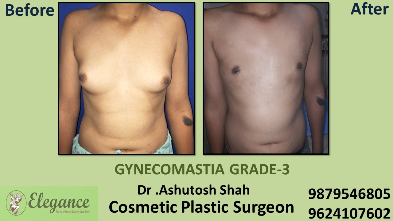 Gynecomastia Grade-3 Treatment in Kosambsa, Gujarat, India.