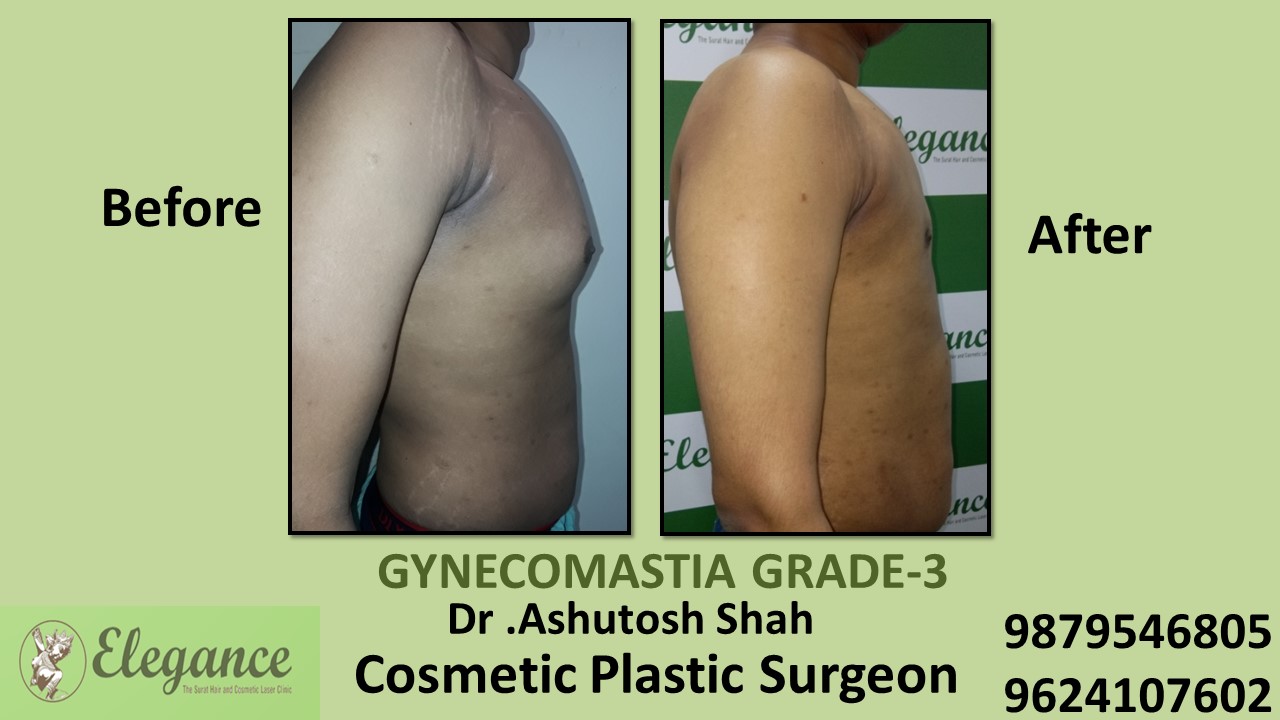 Gynecomastia Grade-3 Treatment in Navsari, Gujarat, India.