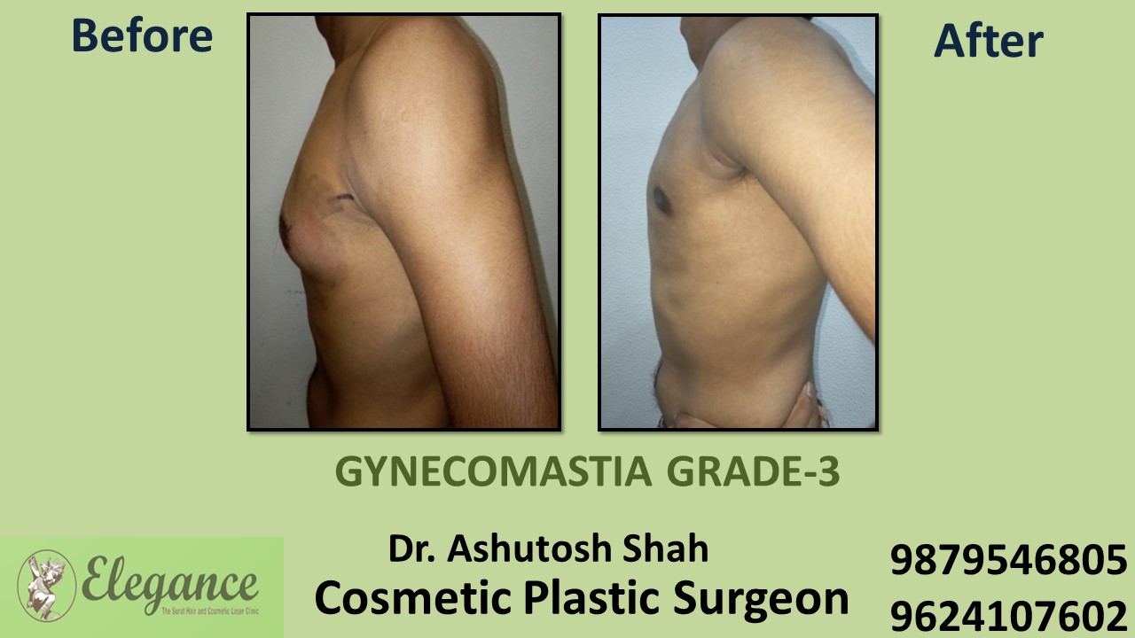 Gynecomastia Grade-3 Treatment in Sachin, Surat, Gujarat.