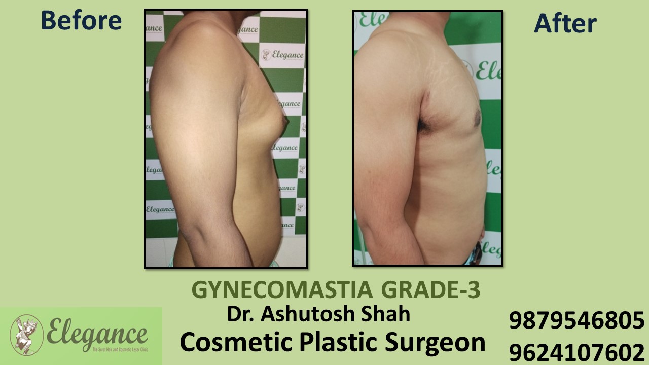 Gynecomastia Grade-3 Treatment in Selvasa, Gujarat, India.
