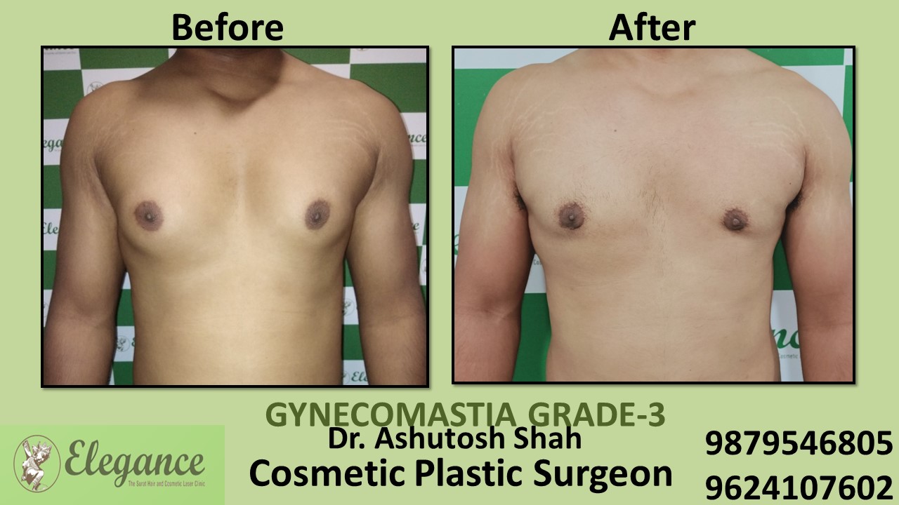 Gynecomastia Grade-3 Treatment in Surat, Gujarat, India.