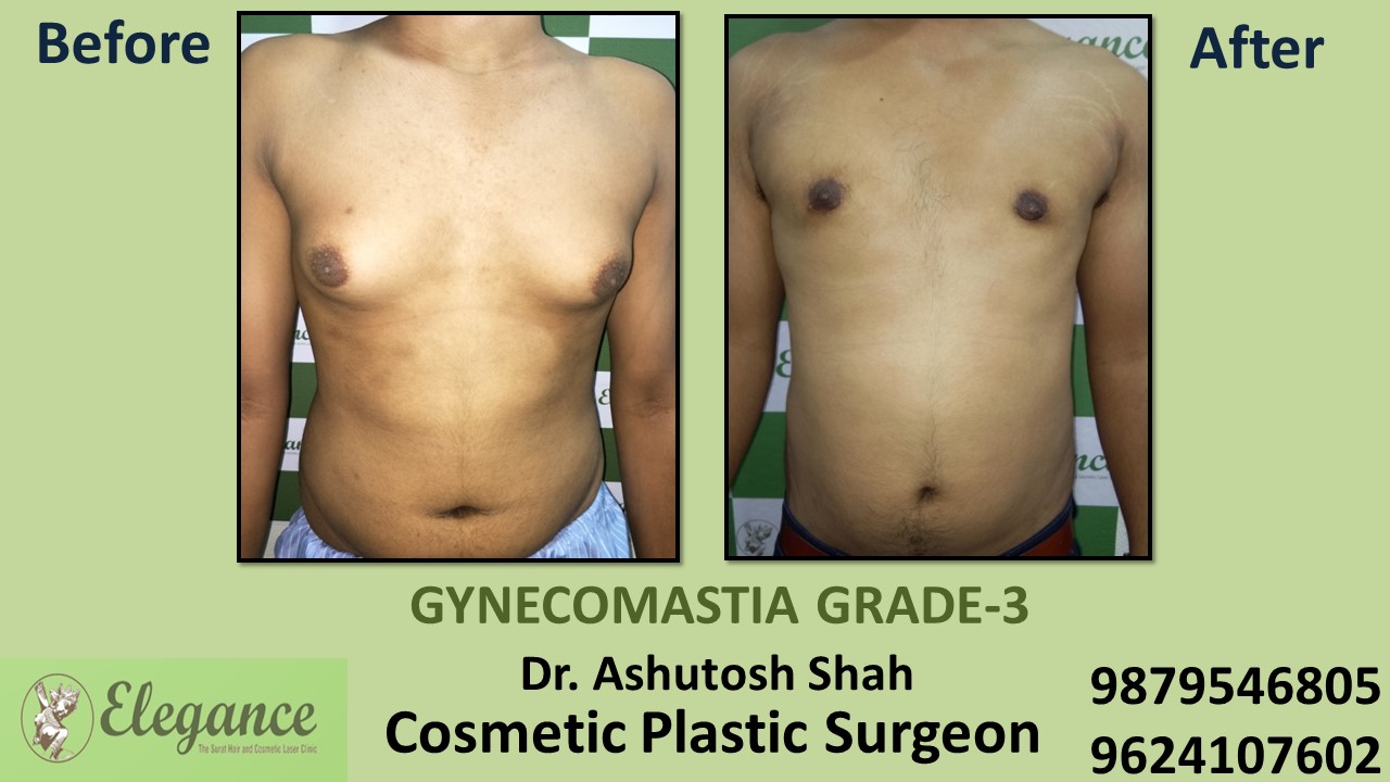 Gynecomastia Grade-3 Treatment in Vadodara, Gujarat, India.