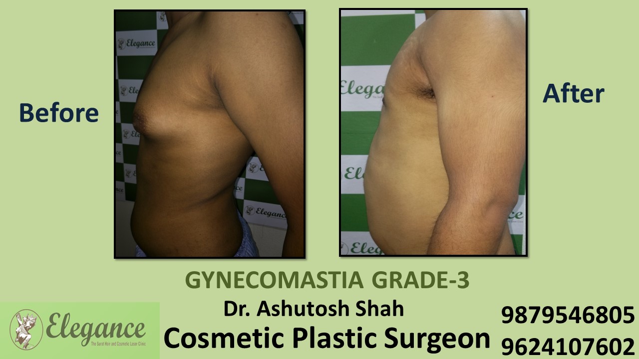 Gynecomastia Grade-3 Treatment in Valsad, Gujarat, India.