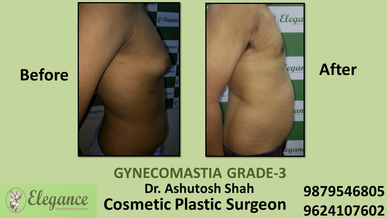 Gynecomastia Grade-3 Treatment in Vapi, Gujarat, India.