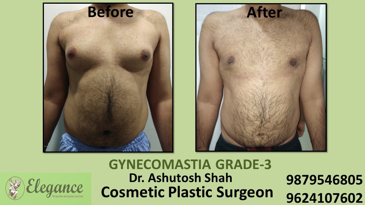 Gynecomastia Grade-3 Treatment, Kamrej, Gujarat, India.