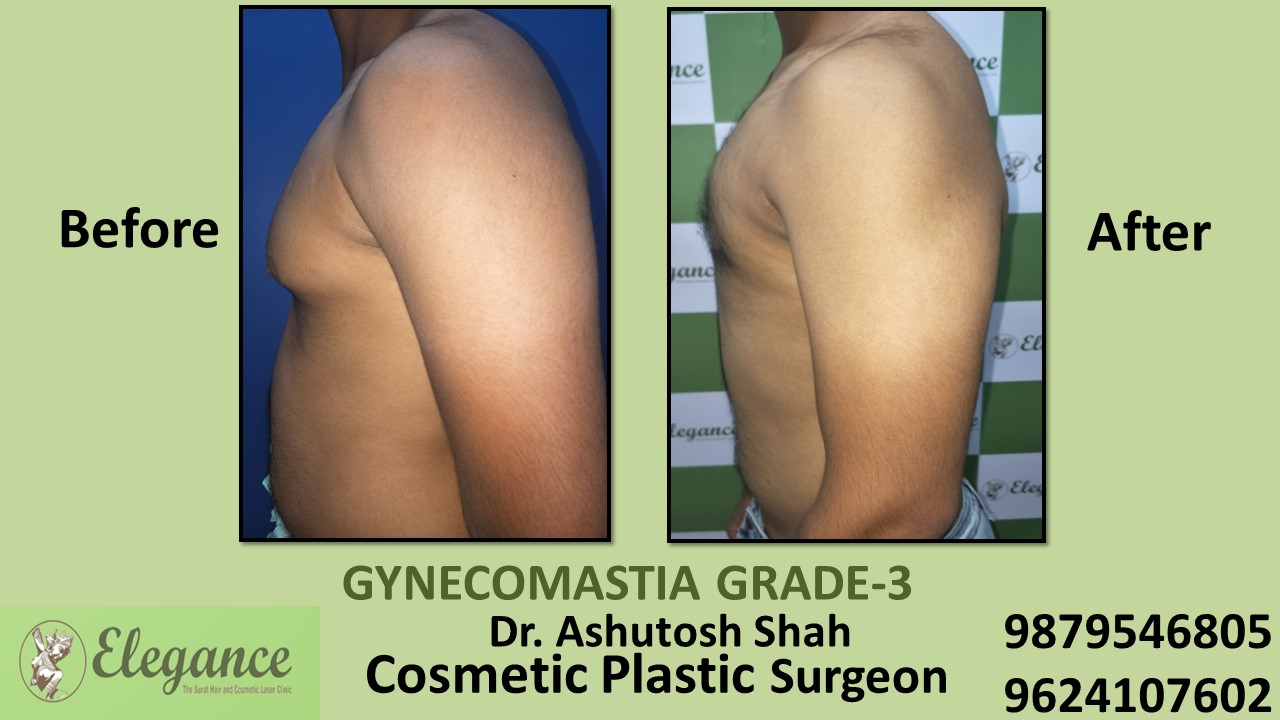 Gynecomastia Grade-3 Treatment, Kim, Gujarat, India.
