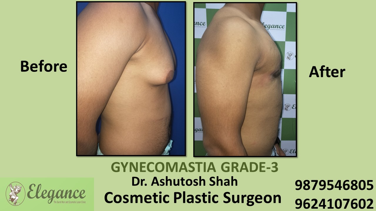 Gynecomastia Grade-3 Treatment, Kosamba, Gujarat, India.
