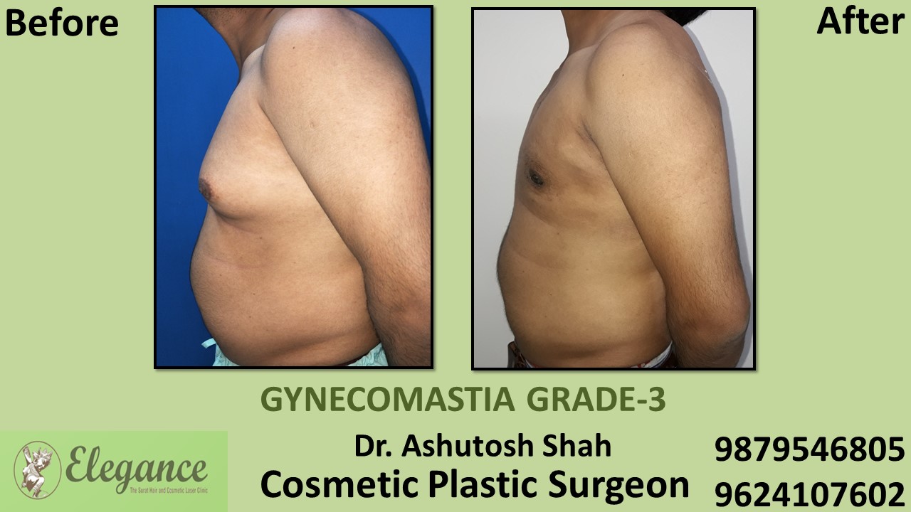 Gynecomastia Grade-3 Treatment, Mangrol, Gujarat, India.