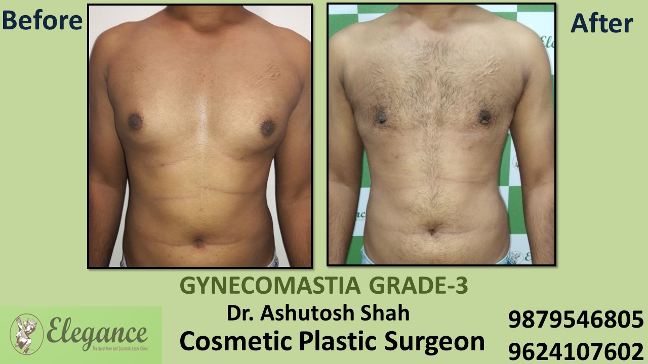 Gynecomastia Grade-3 Treatment, Navsari, Gujarat, India.