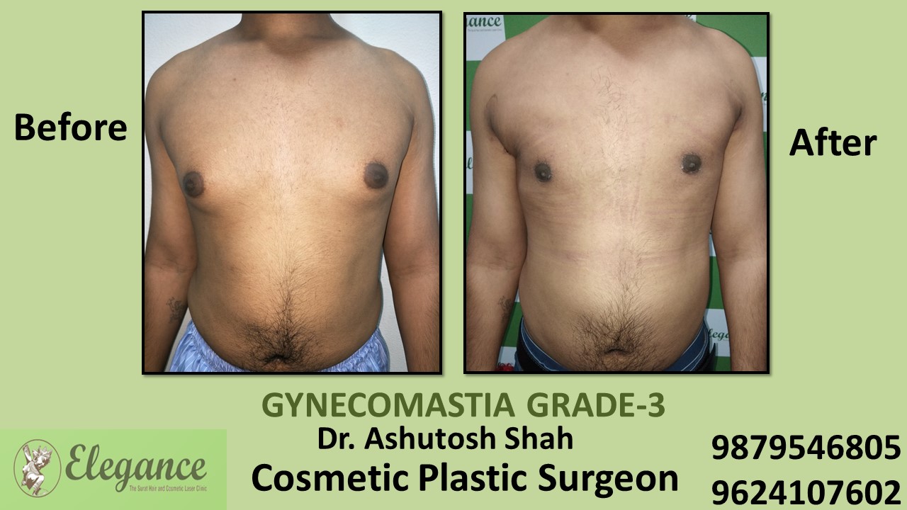 Gynecomastia Grade-3 Treatment, Sachin, Surat, Gujarat, India.