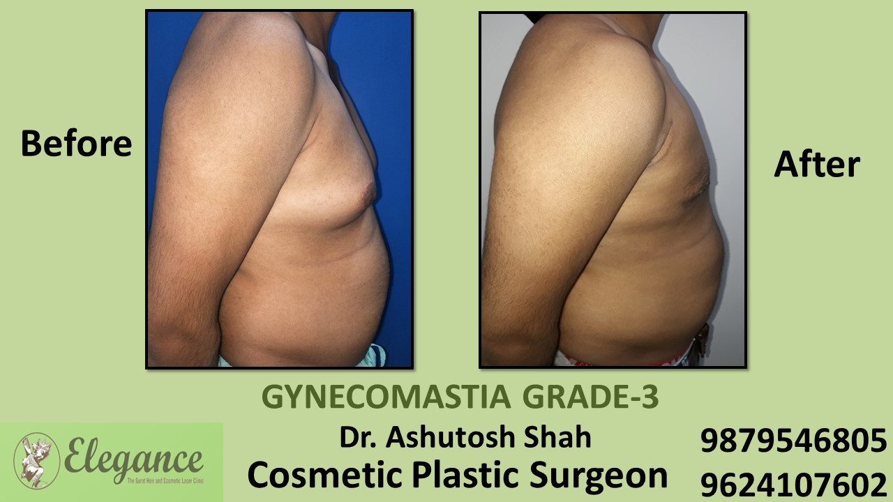 Gynecomastia Grade-3 Treatment, Selvasa, Gujarat, India.