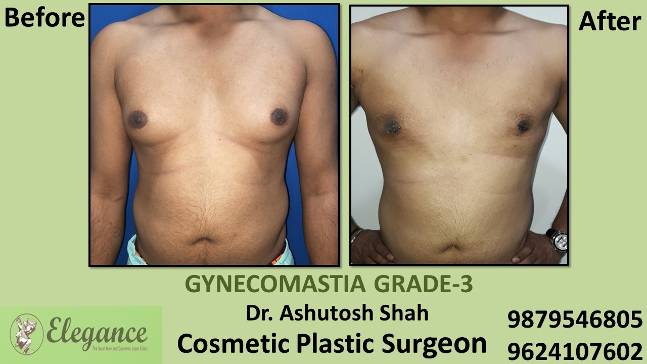 Gynecomastia Grade-3 Treatment, Surat, Gujarat, India.