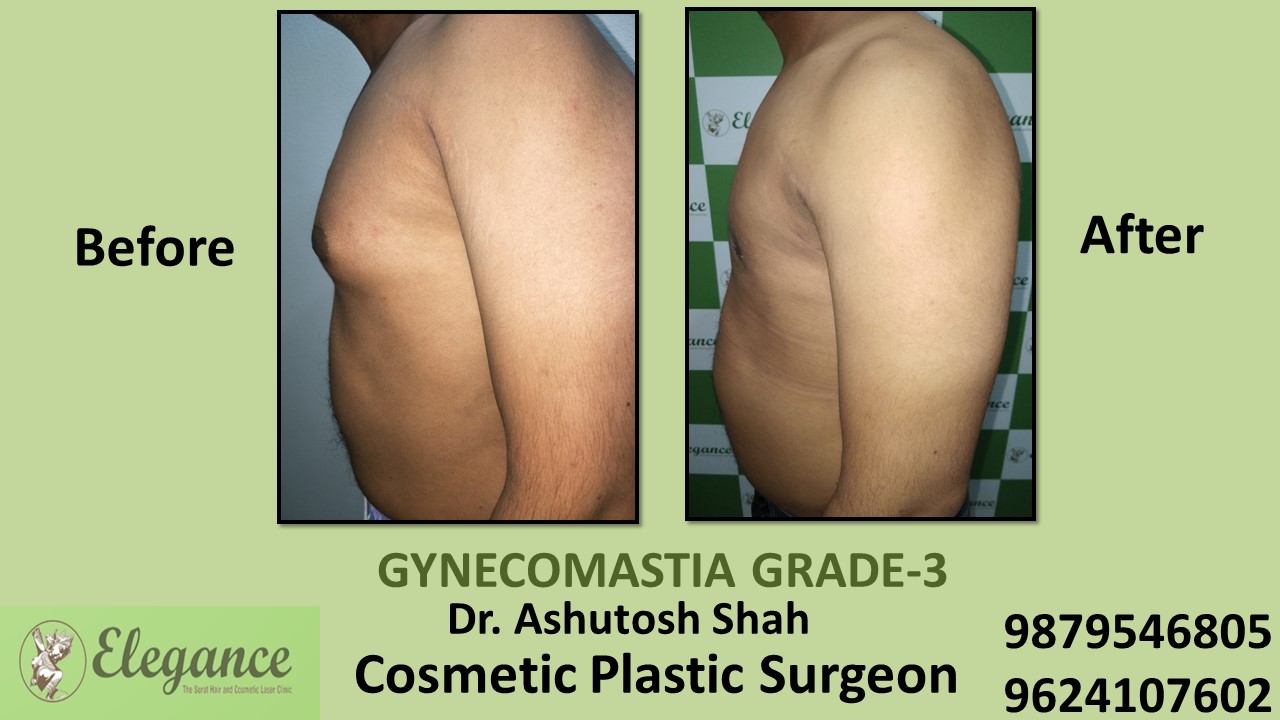 Gynecomastia Grade-3 Treatment, Vadodara, Gujarat, India.