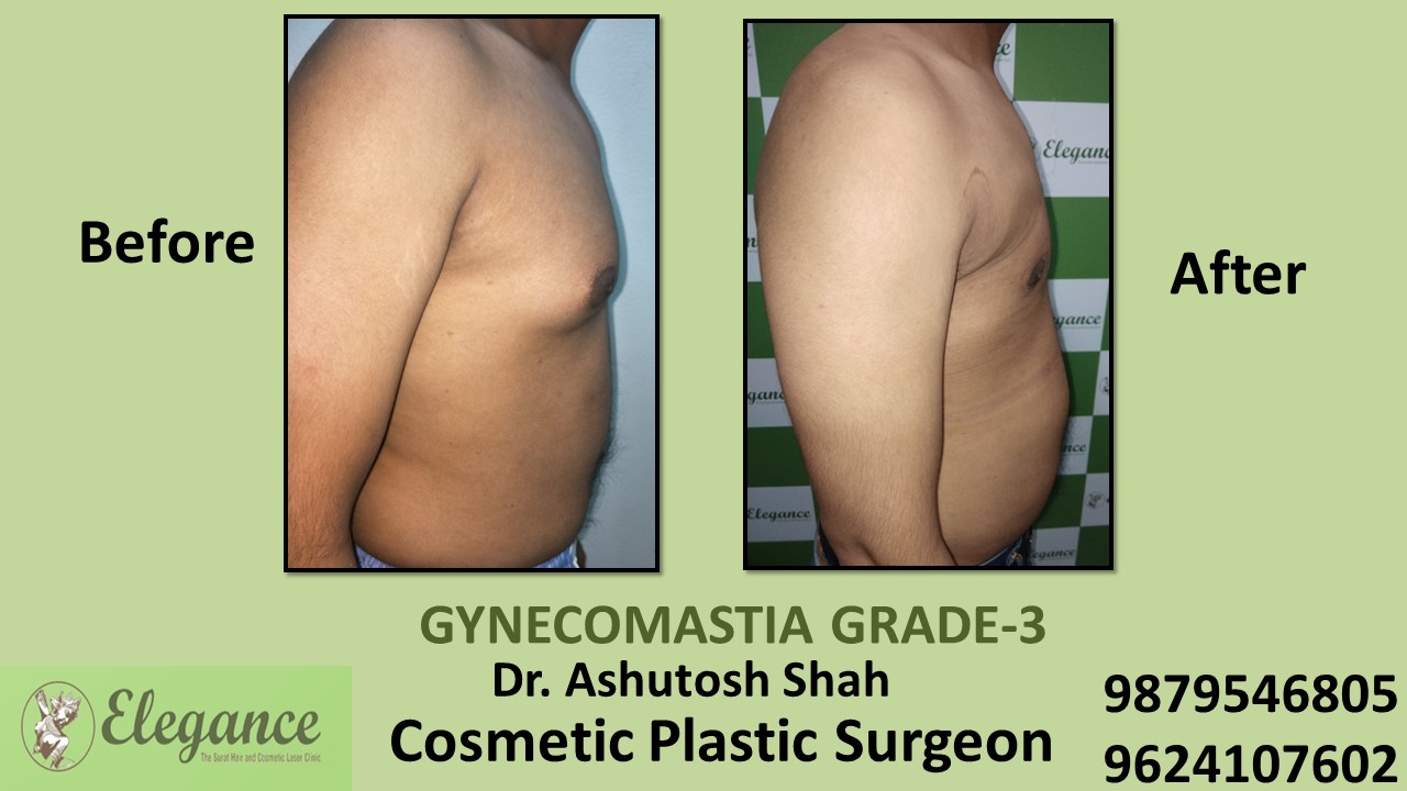 Gynecomastia Grade-3 Treatment, Valsad, Gujarat, India.
