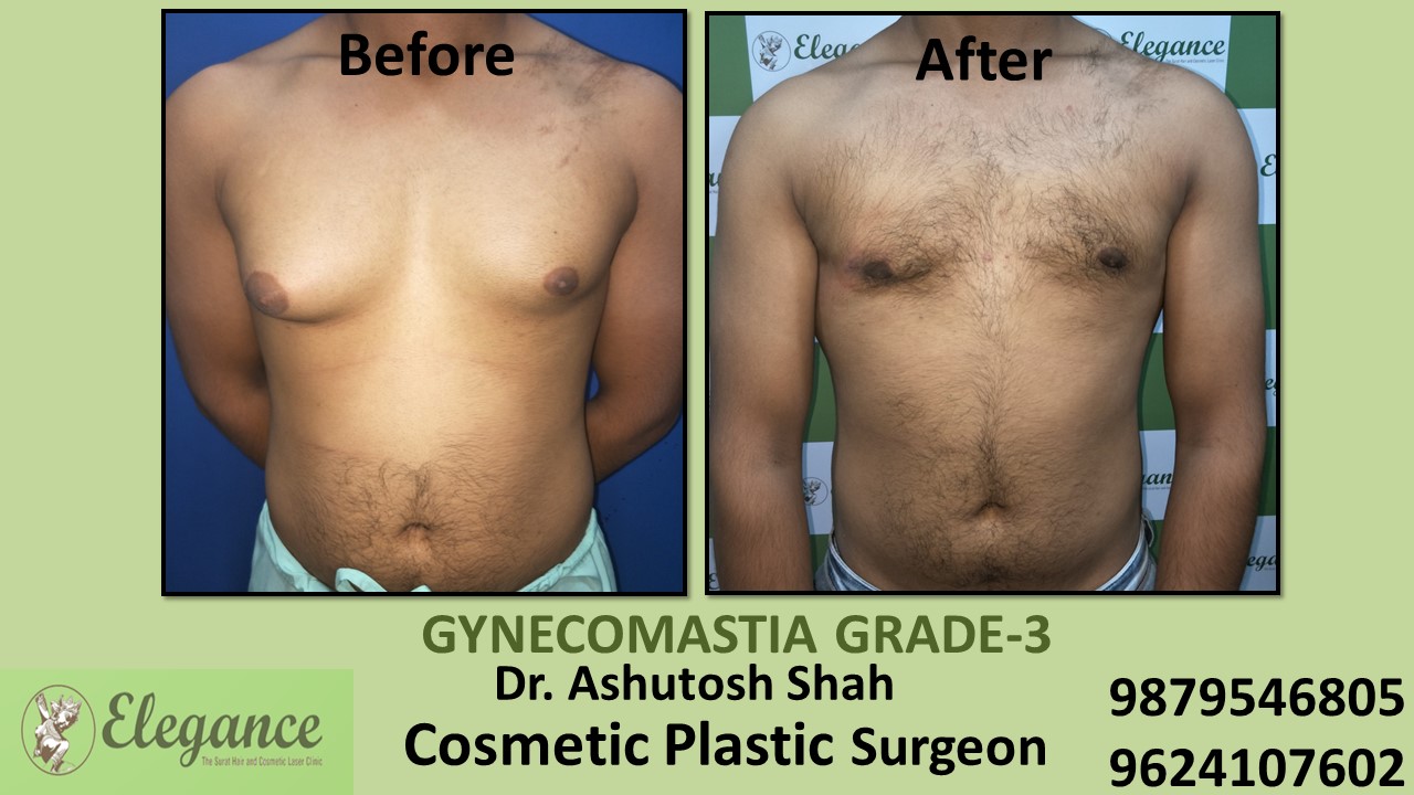 Gynecomastia Grade-3 Treatment, Vapi, Gujarat, India.
