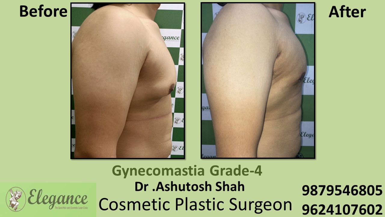 Gynecomastia Grade-4 Moderate Breast Roll Surgery, Ankleshwar, Gujarat, India.