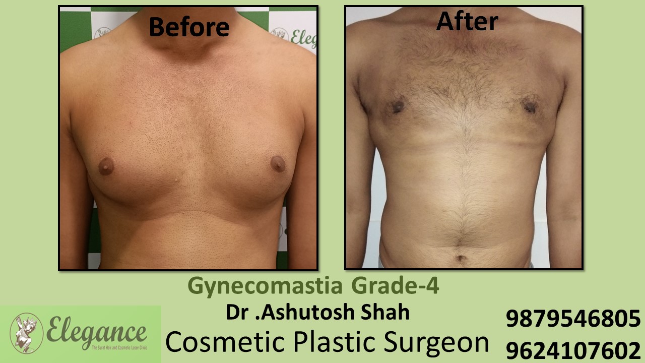 Gynecomastia Grade-4 Moderate Breast Roll Surgery, Bardoli, Gujarat, India.