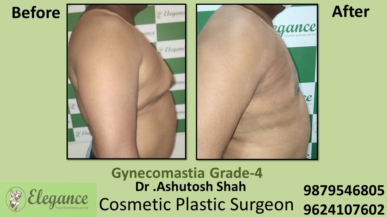Gynecomastia Grade-4 Moderate Breast Roll Surgery, Bharuch, Gujarat, India.