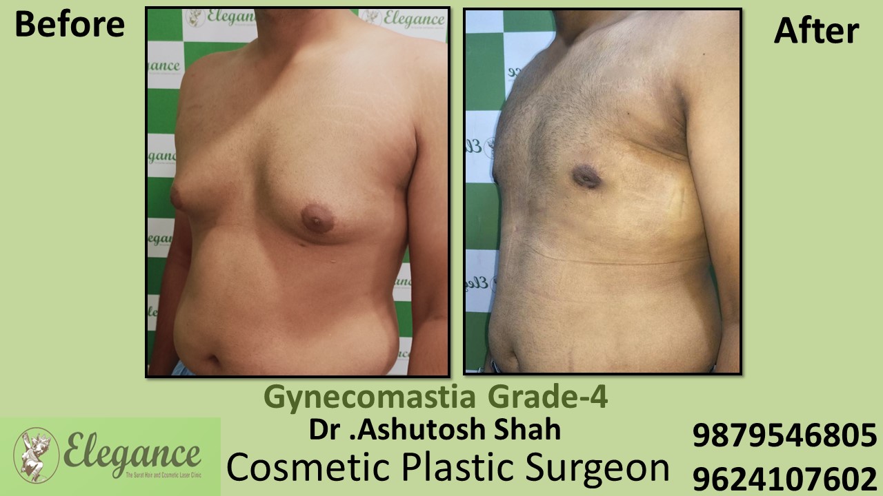 Gynecomastia Grade-4 Moderate Breast Roll Surgery, Bilimora, Gujarat, India.