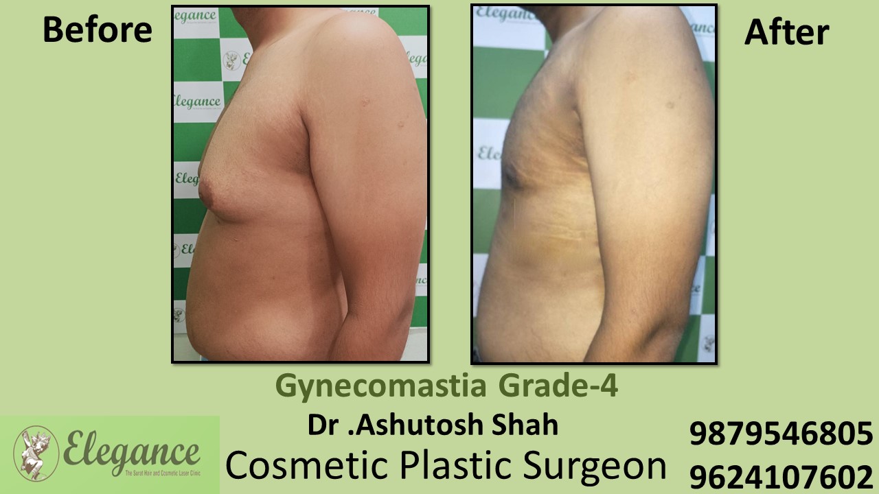 Gynecomastia Grade-4 Moderate Breast Roll Surgery, Daman, Gujarat, India.