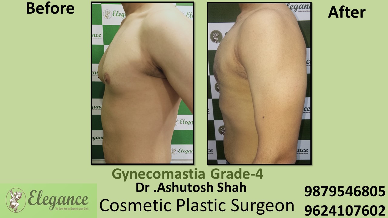 Gynecomastia Grade-4 Moderate Breast Roll Surgery, Kim, Gujarat, India.