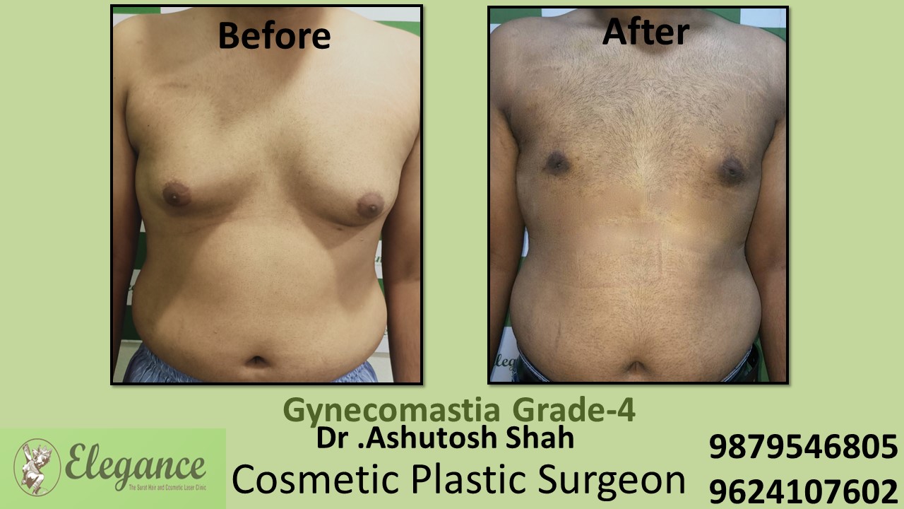 Gynecomastia Grade-4 Moderate Breast Roll Surgery, Kosamba, Gujarat, India.