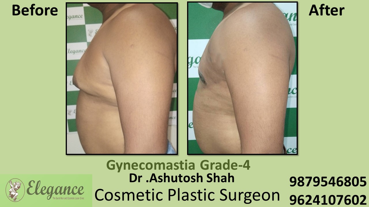 Gynecomastia Grade-4 Moderate Breast Roll Surgery, Navsari, Gujarat, India.
