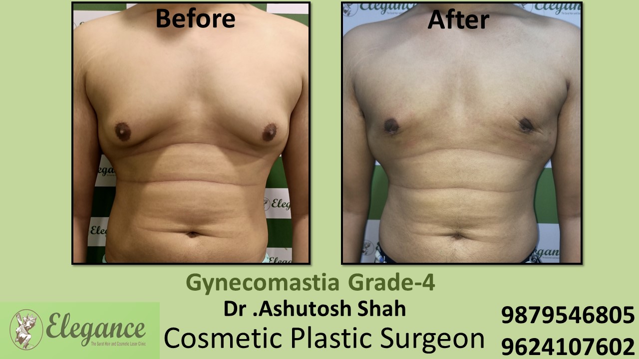 Gynecomastia Grade-4 Moderate Breast Roll Surgery, Surat, Gujarat, India.