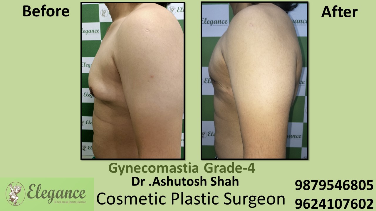 Gynecomastia Grade-4 Moderate Breast Roll Surgery, Vadodara, Gujarat, India.