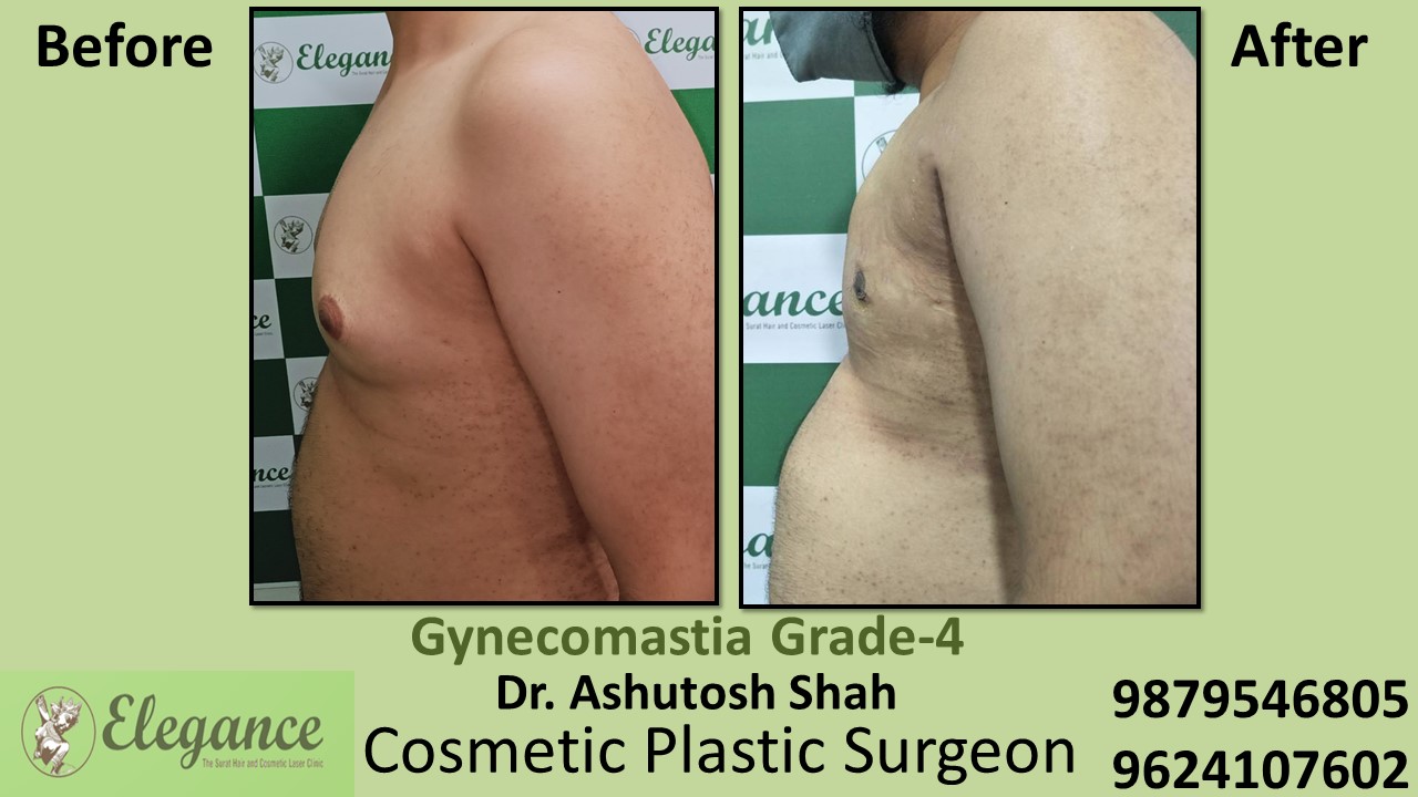 Gynecomastia Grade-4 Moderate Breast Roll Surgery, Valsad, Gujarat, India.