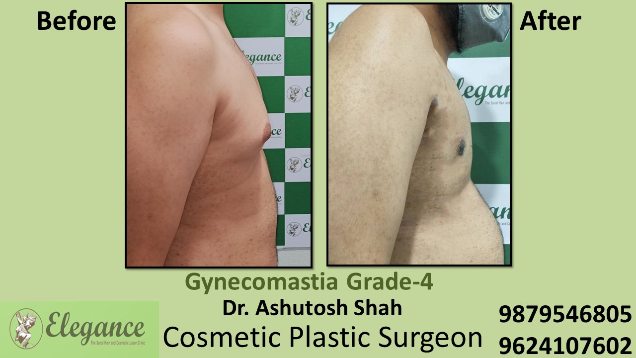 Gynecomastia Grade-4 Moderate Breast Roll Surgery, Vapi, Gujarat, India.
