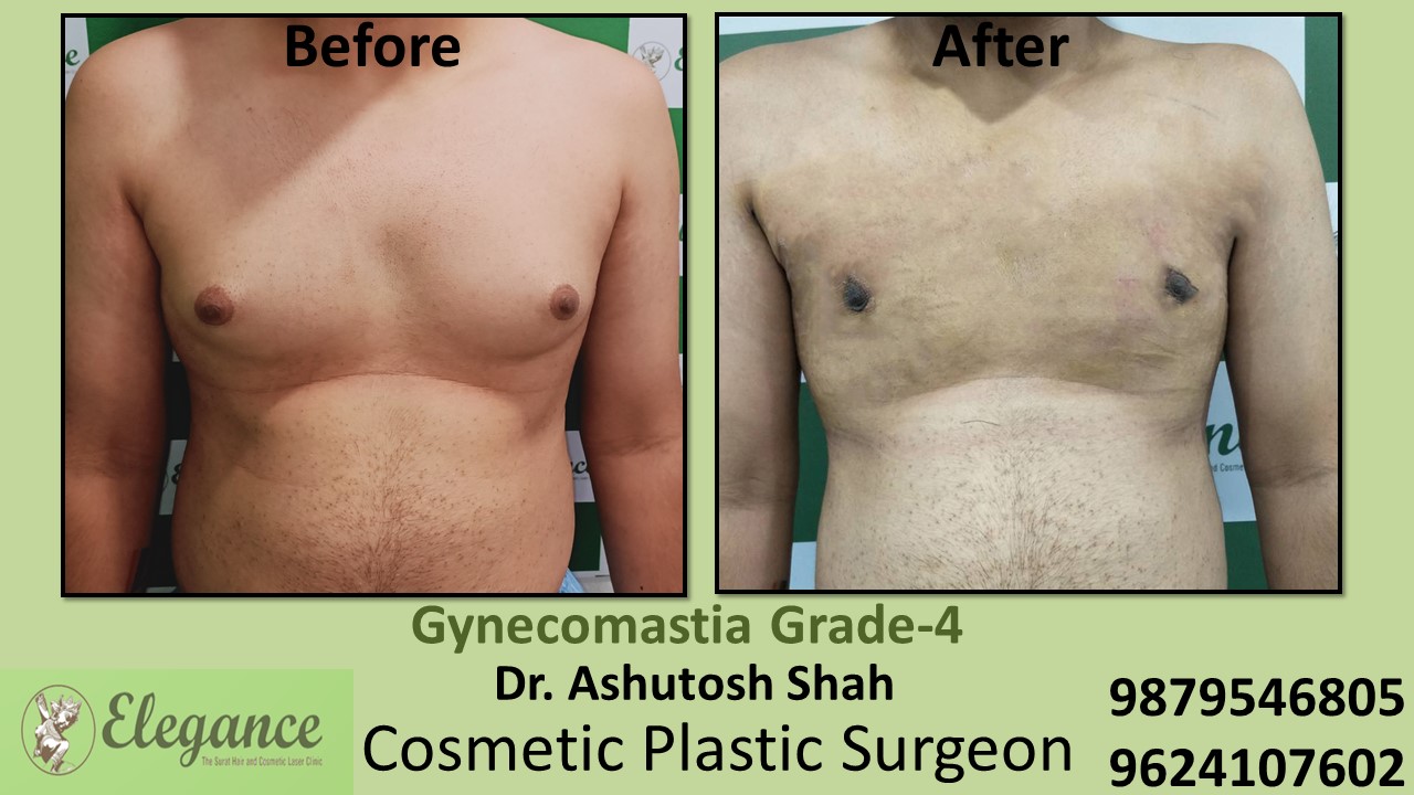 Gynecomastia Grade-4 Moderate Breast Roll Surgery,Chhota Udaipur, Gujarat, India.