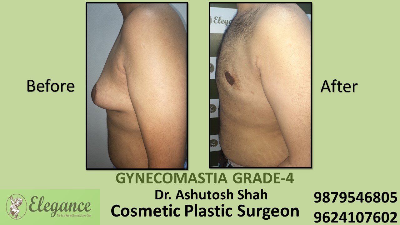Gynecomastia Grade-4 Treatment, Bardoli, Gujarat, India.