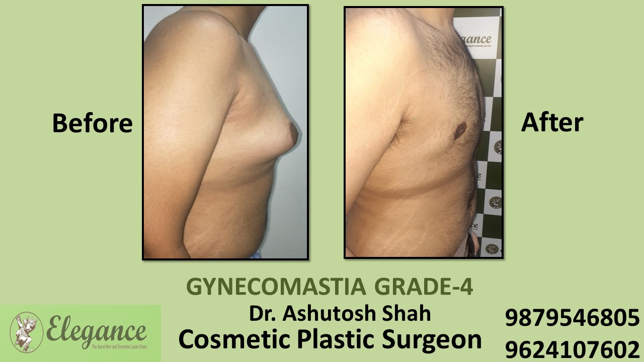 Gynecomastia Grade-4 Treatment, Bharuch, Gujarat, India.