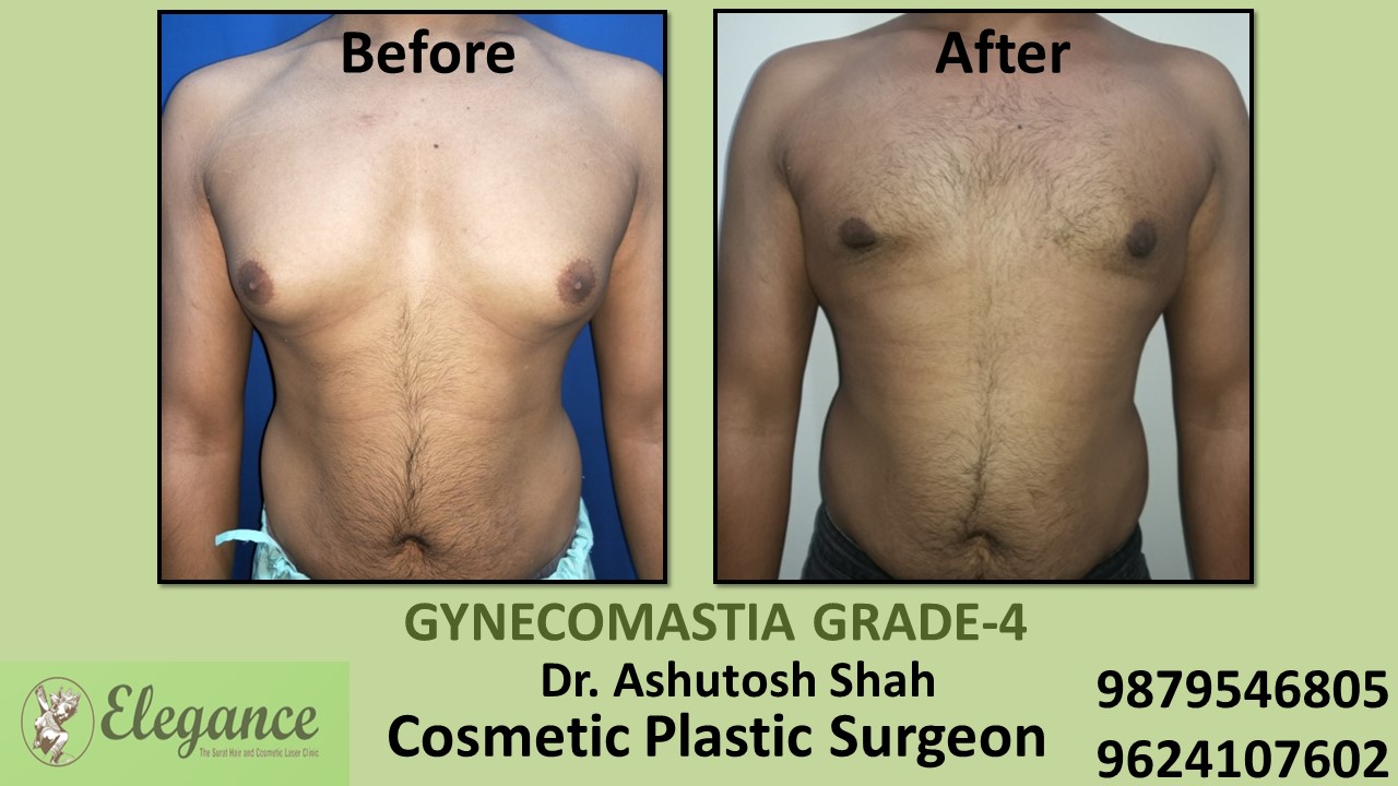 Gynecomastia Grade-4 Treatment, Bilimora, Gujarat, India.
