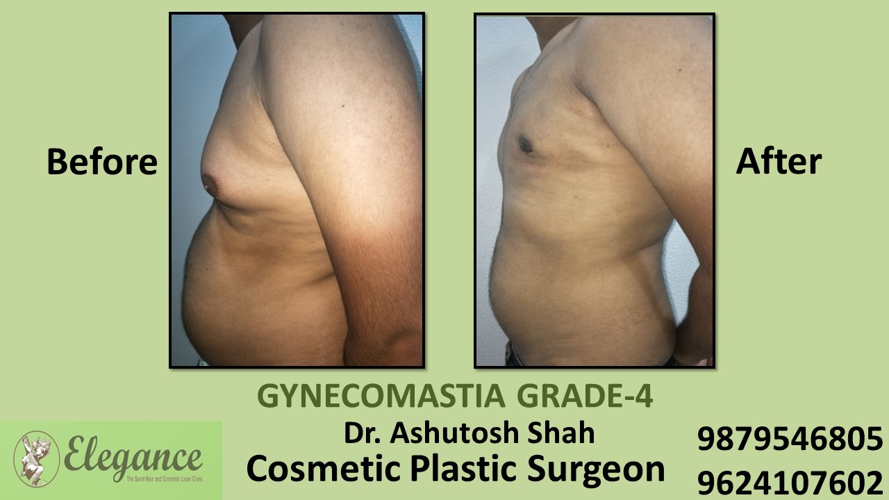 Gynecomastia Grade-4 Treatment, Daman, Gujarat, India.